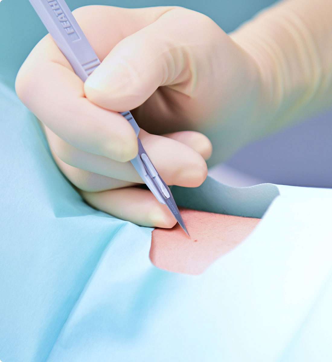 Huidchirurgie